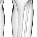 Osteotomy