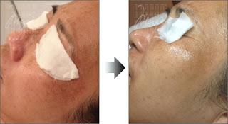 Before…and After Sun Damage