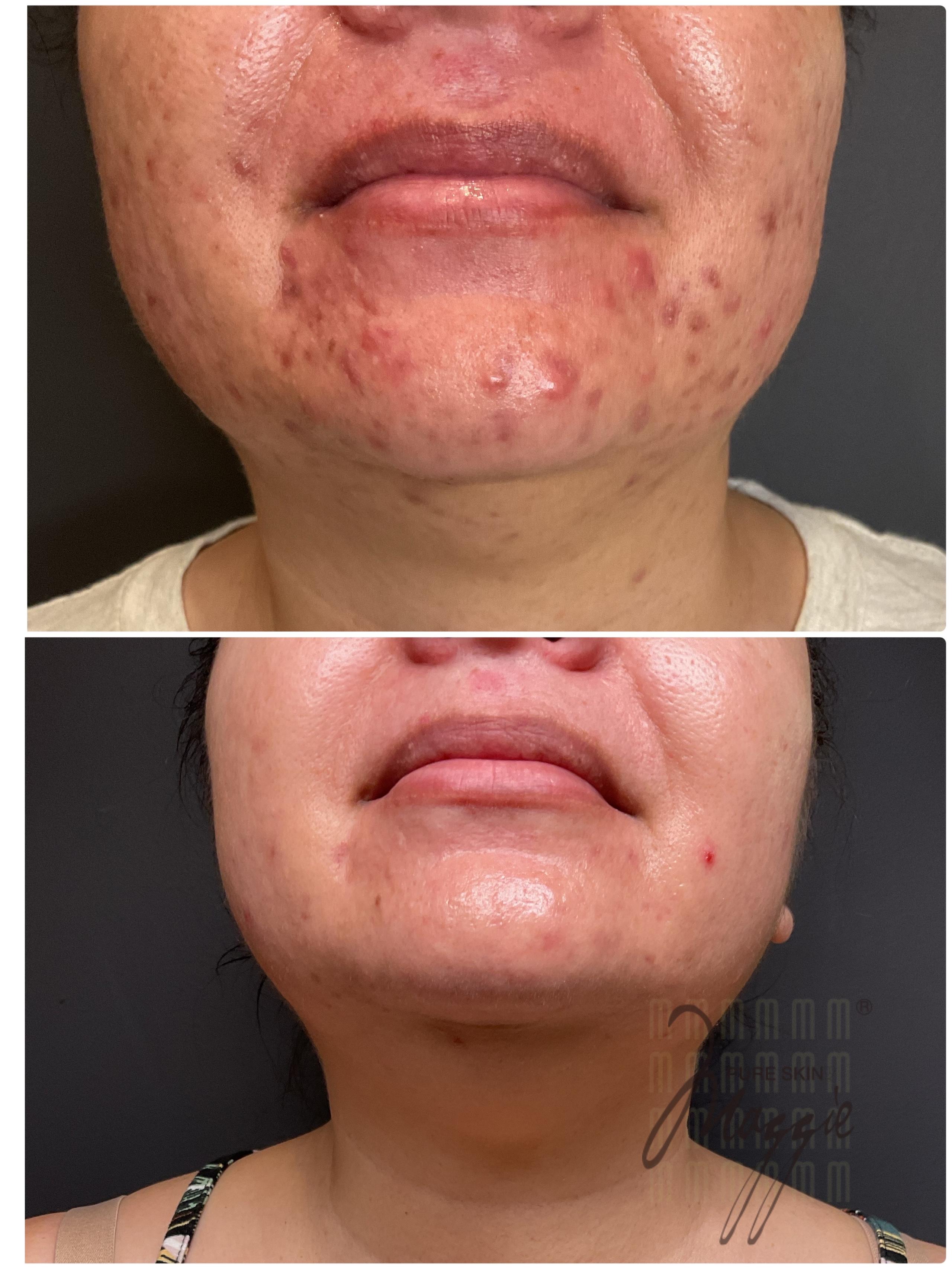 Acne Treatment in Honolulu | Real Results at Pure Skin by Maggie