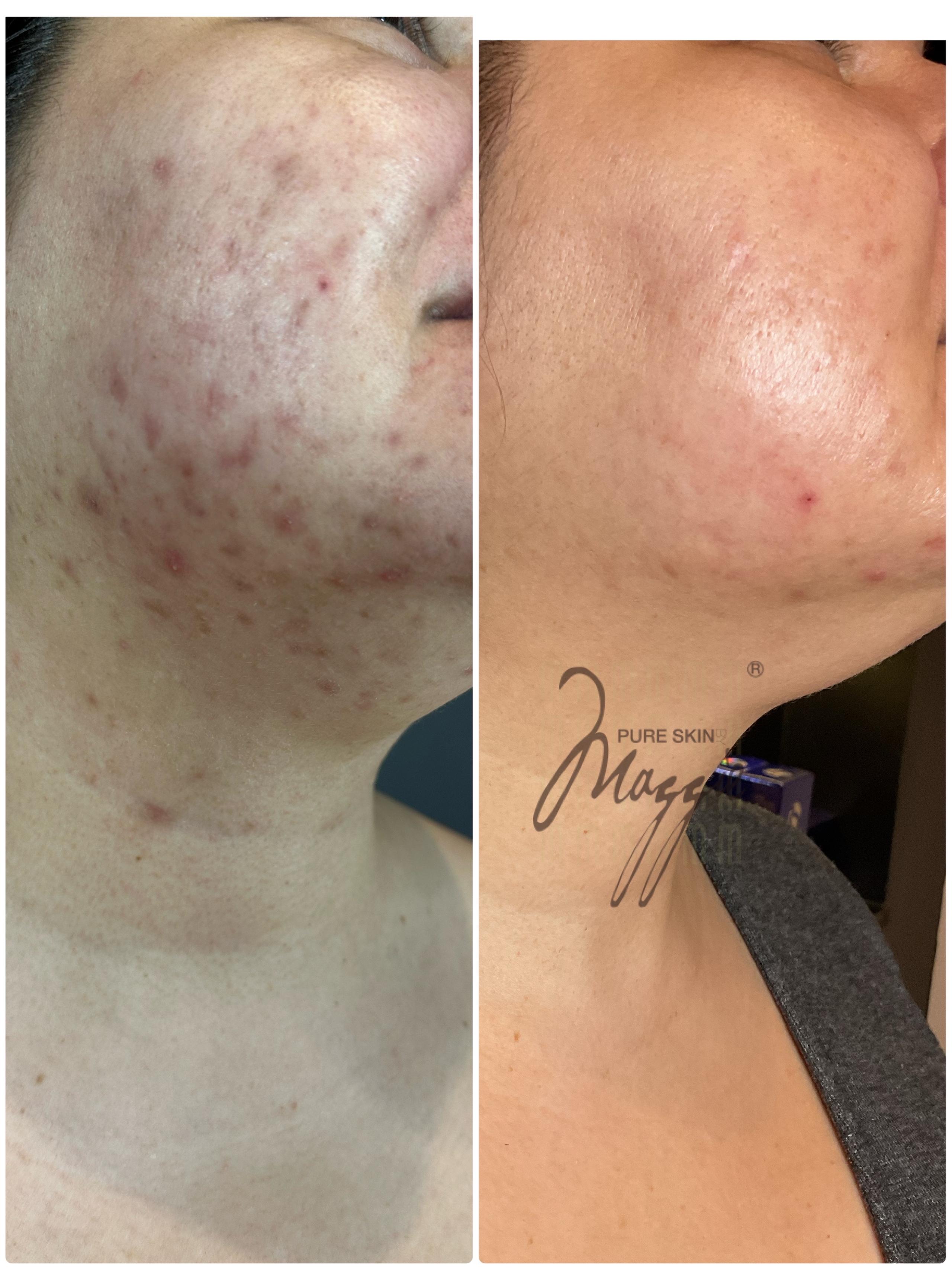 Acne Scar Treatment  in Honolulu