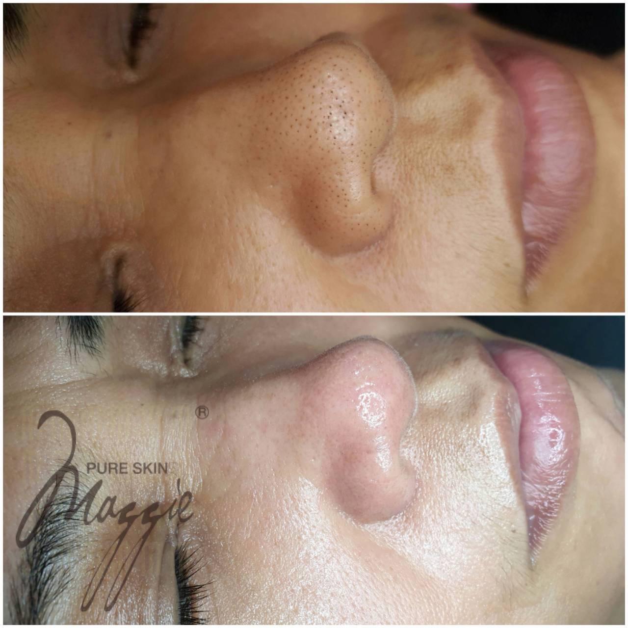HydraFacial in Honolulu: Deep Cleansing Results for Congested Pores